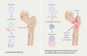 Illustration Myelom