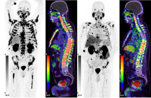 Maximum-Intensity-Projektionen (MIP) und PET/CT-Fusionsbilder einer [⁶⁸Ga]Ga-PSMA-I&T-PET-Untersuchung eines mCRPC-Patienten mit disseminierten Knochenmetastasen vor Therapie (links) sowie nach zwei Zyklen [¹⁷⁷Lu]Lu-PSMA-617 (rechts), die eine partielle Remission zeigen.