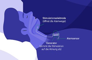 Zungenschrittmacher der Firma Inspire