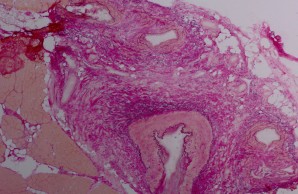 Panarteriitis nodosa in EVG-Färbung. 