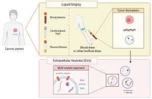 EVs aus Flüssigbiopsien als Biomarker (