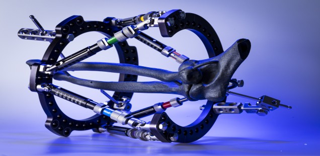  Bild eines 3D-gedruckten Oberarm im Ringfixateur