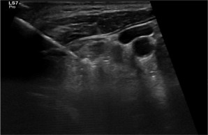 Radiofrequenzablation eines Schilddrüsenknotens in Hamburg 